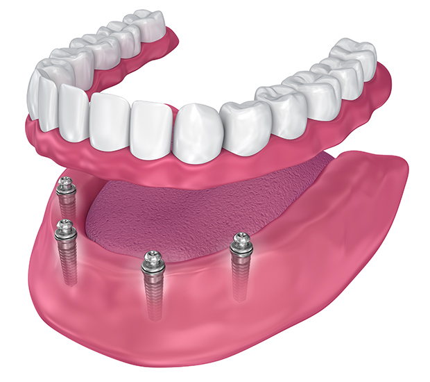 Sacramento All-on-4 Implants