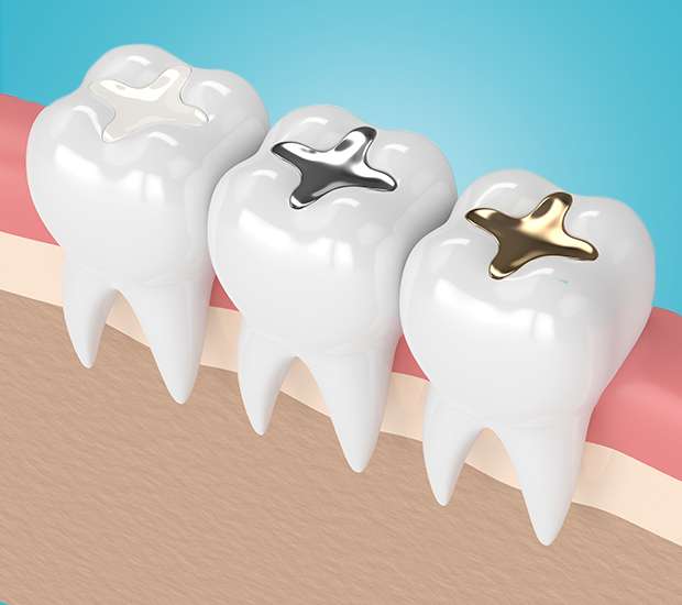 Sacramento Composite Fillings