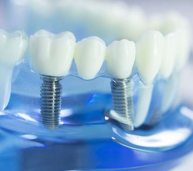 Sacramento Dental Implants