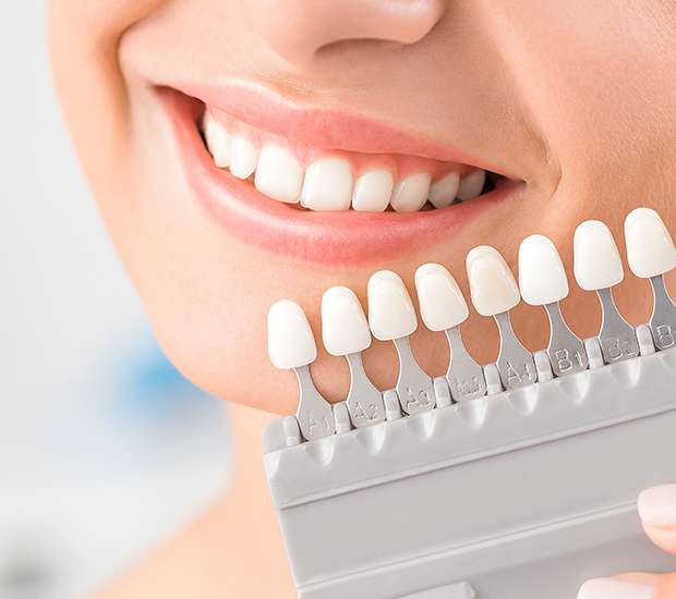 Sacramento Dental Veneers and Dental Laminates