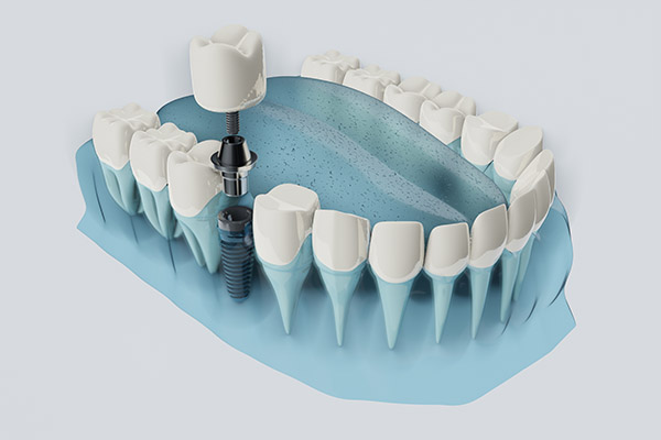 FAQs about Dental Implants from Dental Excellence of Greenhaven in Sacramento, CA