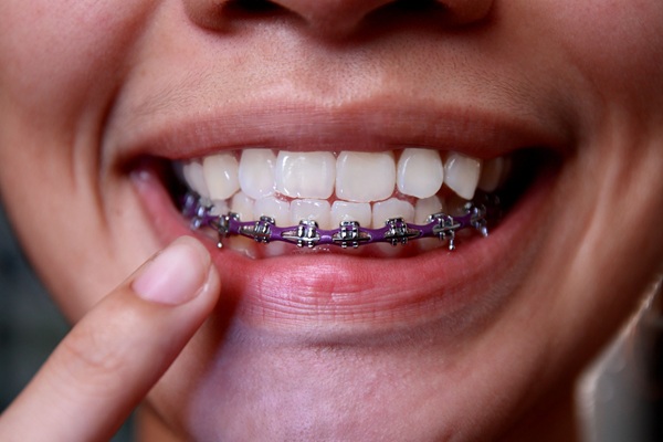Receiving Fastbraces From A General Dentist
