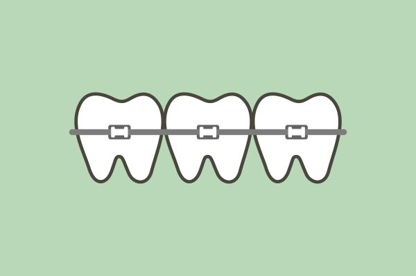 invisible Orthodontic Treatment (Braces)