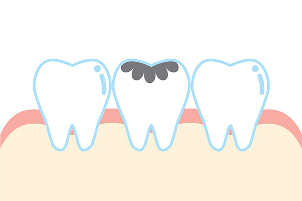 Dental Practice FAQs: How Are Cavities Treated? from Dental Excellence of Greenhaven in Sacramento, CA