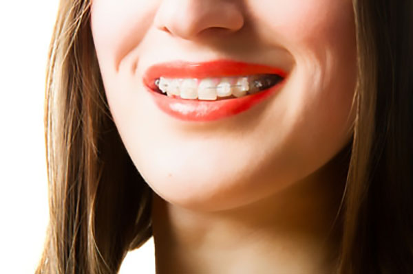 How Long Do Treatments With Clear Braces Last?