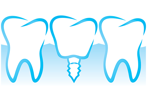 Questions To Ask Your Dentist At Your Implant Dentures Consultation