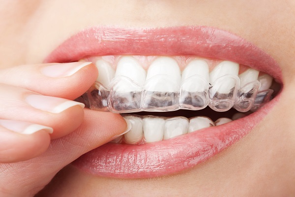 Invisalign Sacramento, CA