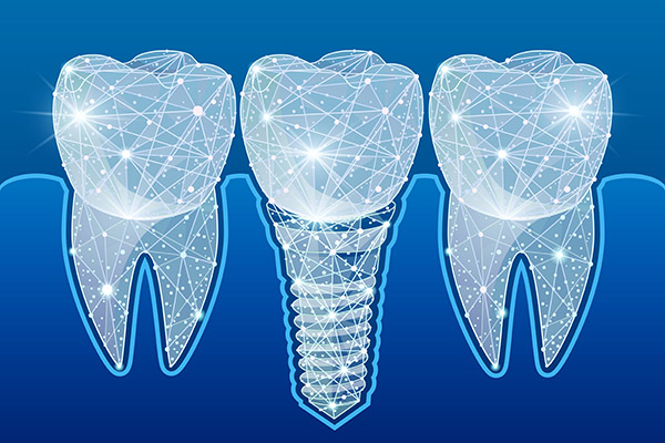 Preventing Complications After Getting Dental Implants from Dental Excellence of Greenhaven in Sacramento, CA