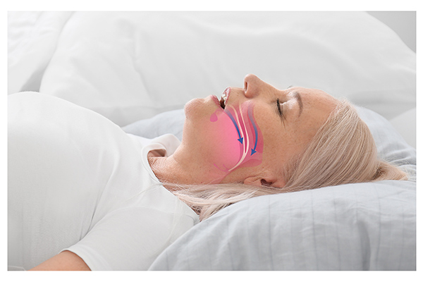 How A General Dentist Can Help Your Sleep Apnea Treatment With An Oral Appliance