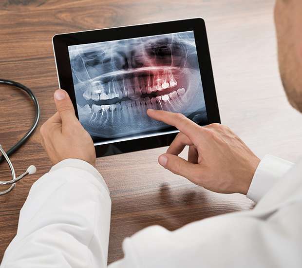 Sacramento Types of Dental Root Fractures