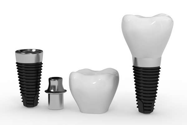 What Are the Parts of Dental Implants from Dental Excellence of Greenhaven in Sacramento, CA