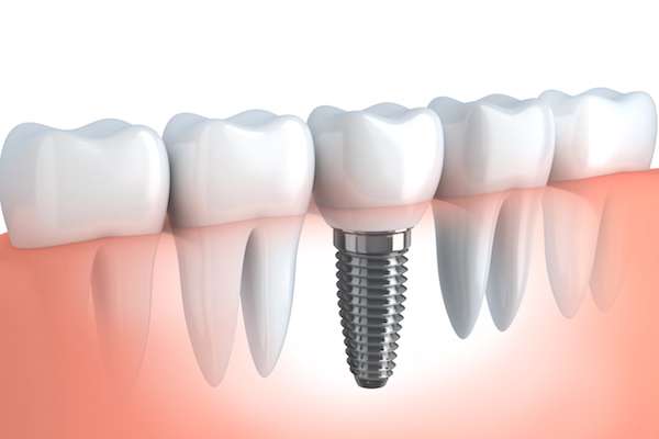 Your Ultimate Guide to Getting Dental Implants from Dental Excellence of Greenhaven in Sacramento, CA